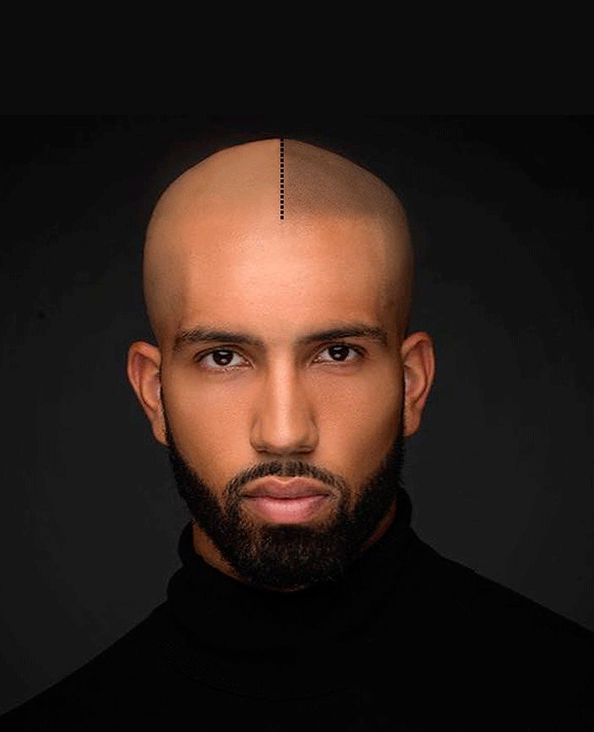 Tábanas micropigmentacion